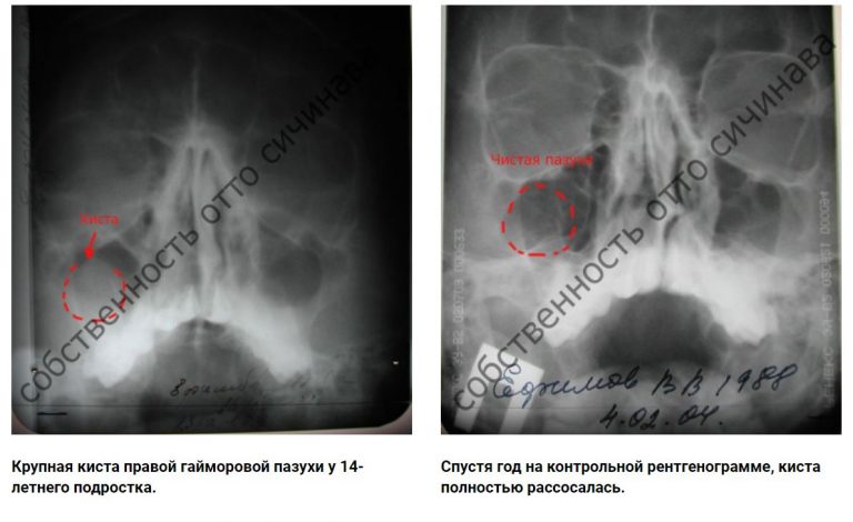 Гипертрофия нижних носовых раковин фото